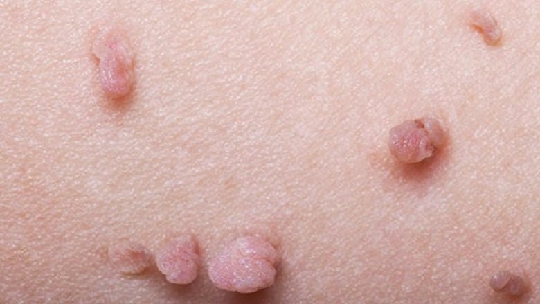 How to Prepare for Skin Tag Removal in Dubai Procedures